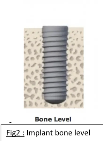 Fig2 : Implant bone level 