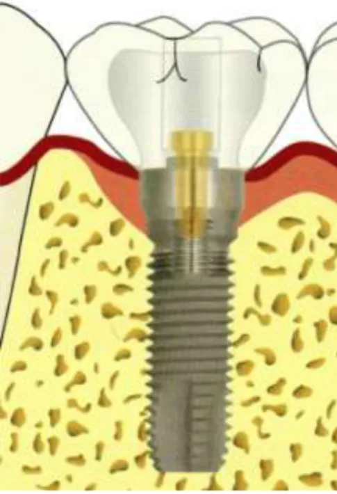 Fig 8 : Prothèse supra-implantaire transvissée par l’intermédiaire d’un pilier transgingival