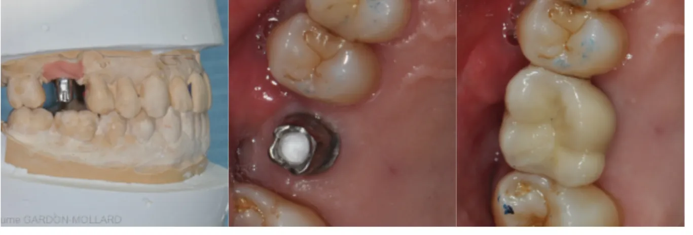 Fig 9 : Prothèse supra-implantaire scellée du Dr Guillaume GARDON-MOLLARD 