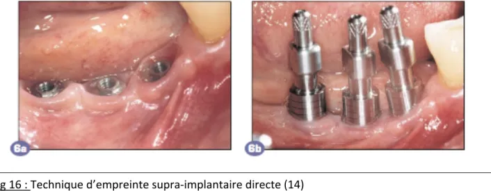 Fig 16 : Technique d’empreinte supra-implantaire directe (14)  a) Situation clinique avec 3 implants, piliers de cicatrisation dévissés  b) Pilier pick-up mis en place sur les implants 