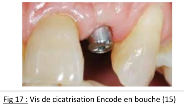 Fig 17 : Vis de cicatrisation Encode en bouche (15) 