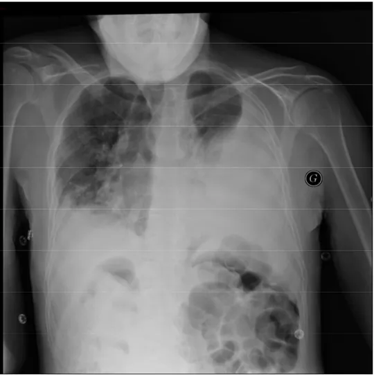 Figure 2: Radiographie pulmonaire de face, PP gauche de grande abondance, libre, foyer de pneumopathie  controlatérale
