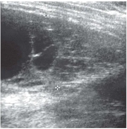 Figure 6: Echographie thoracique, multiples cloisons hyperéchogènes au sein d'un liquide anéchogène