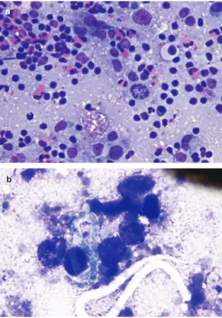 Figure 10   CT image of the  nodule pictured in Figure 5b. 