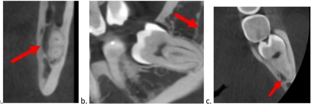 Figure 6 : Extraits de coupes de CBCT de 38. 