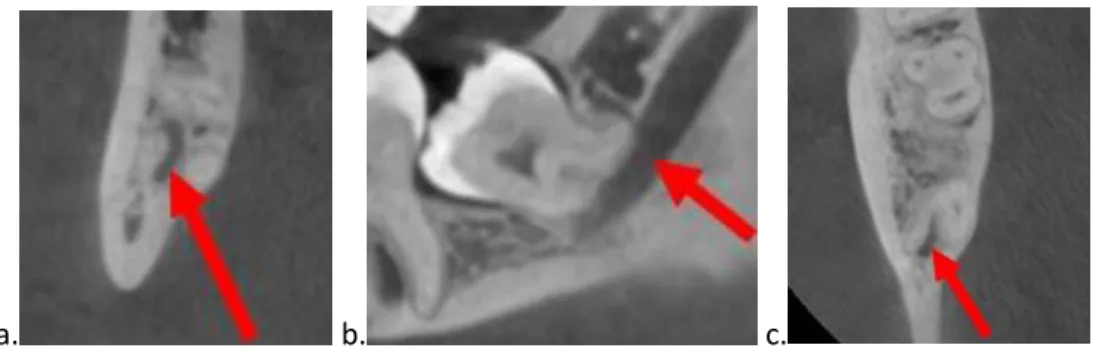 Figure 9 : Coupe frontale (a), sagittale(b) et axiale(c) de 48.  