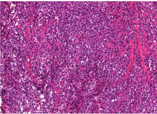 Figure 4 : sarcome d’Ewing : prolifération dense faite de petites cellules rondes monomorphes