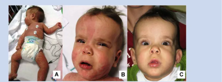 FIG. 1. A: Patient at 8 months. Note the generalized aspect of the capillary malformation