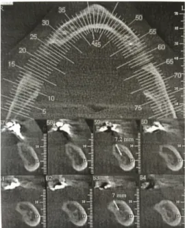 Figure   1:   Coupes   radiographiques:   Hauteur   d'os   de                                                                                                                                                                                                   
