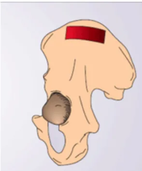 Figure   4:   Zone   de   prélèvement   iliaque   (4)     