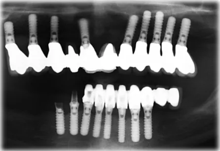 Figure   16:   Radiographie   panoramique   pré-­‐opératoire       