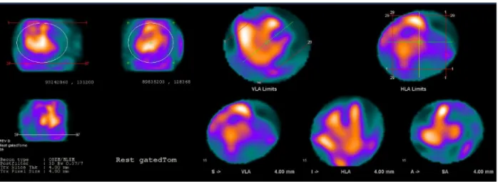 Figure 5. First step of the analysis with centering of cardiac cavities in ventriculography 