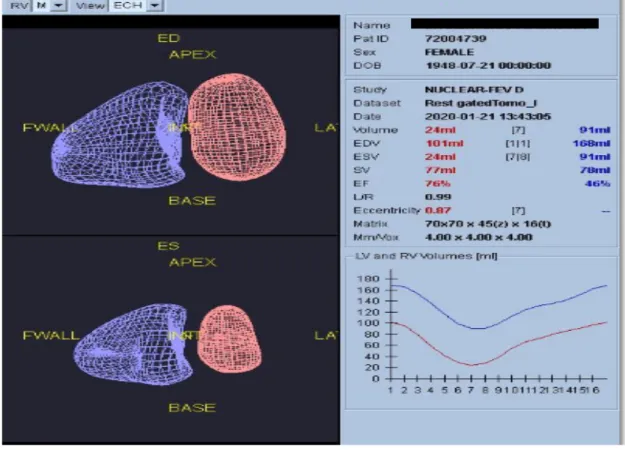 Figure 8. Final reconstruction of right (blue) and left (red) ventricles with fractions and volumes 