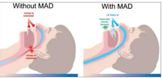Figure 2 : Schéma représentant l’effet de la mise en place d’une gouttière d’avancée mandibulaire 