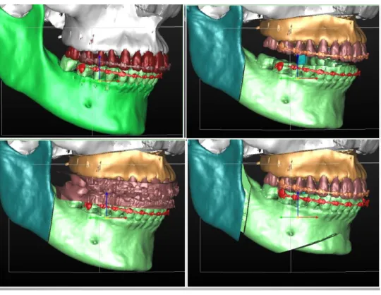Figure 6 : Exemple de repositionnement de modèles 3D maxillaires et mandibulaires avec correction  d’un excès vertical maxillaire et mandibulaire 
