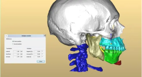 Figure 8 : Schéma représentant la simulation 3D de l’ostéotomie en haut : vue sagittale, en bas : vue  horizontale 