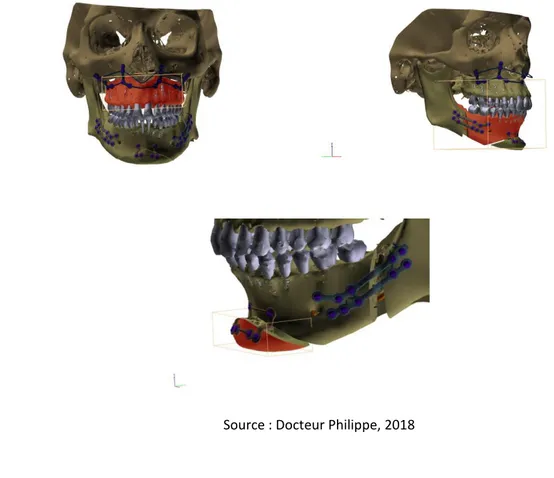 Figure 9 : Image représentant les guides et plaques sur mesure CAD CAM 