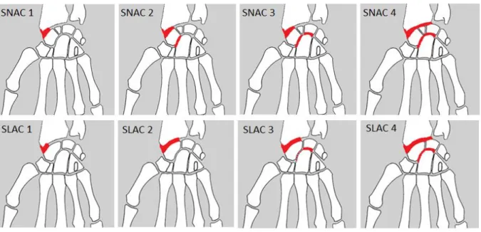 Figure 2 : schéma des 4 stades de l’arthrose selon l’étiologie SNAC et SLAC. 