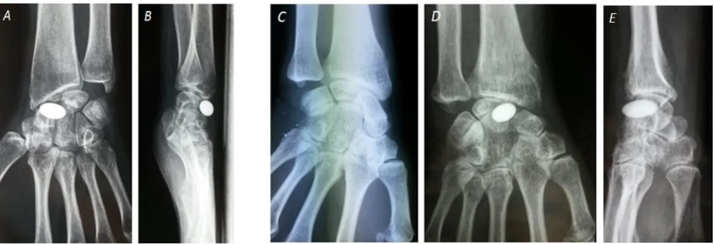 Figure 5 : luxations de l’implant. 