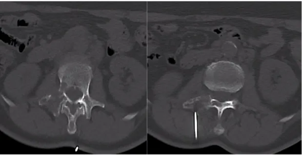 Figure 1: CT guided biopsy of focal osteolysis of right transverse process extended  to pedicle