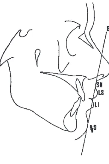 Figure 3 (11) : ligne B avec SN = point sous nasal, LS= lèvre supérieure, LI= lèvre inférieure, PgS= pogonion cutané 