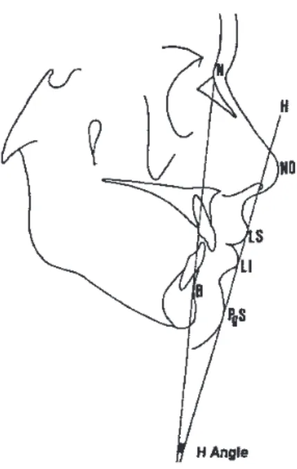 Figure 4 (11) : ligne H avec N= nasion, NO= pointe du nez, LS= lèvre supérieure, LI= lèvre inférieure, PgS= pogonion  cutané 