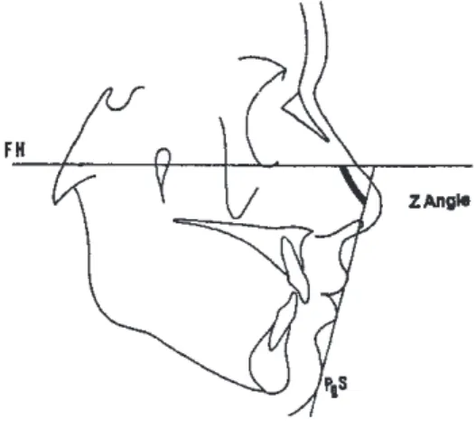 Figure 6 (11) : Angle Z. FH = plan de Francfort et PgS= pogonion cutané 