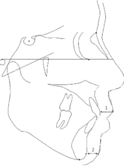 Figure 9 (14) : Epaisseur des tissus mous avec 1= épaisseur de la lèvre supérieure ; 2 = épaisseur du menton mou