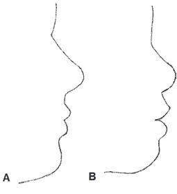 Figure 12 (38): Profils représentant l’angle Z moyen choisi comme acceptable par tous les évaluateurs pour  l’échantillon blanc (A) et (B) pour l'échantillon d'afro-américains