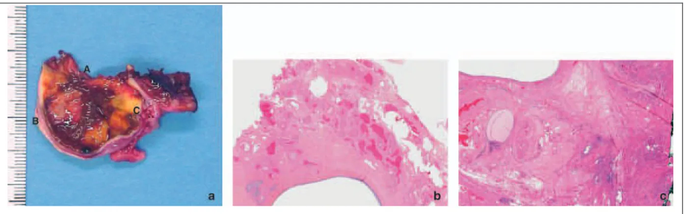 Figure 4 : Les 3 zones d’un endométriome A, B et C. (Roman et al.)  a. Photo macroscopique d’un ovaire porteur d’un endométriome