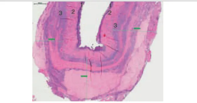 Figure  6 :  Paroi  d’un  endométriome  excisée  par  kystectomie  (coloration  HES  x  4)