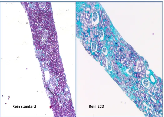 Figure 3 : Exemple illustrant l’histologie de biopsies rénales préimplantatoires issues  d’un  rein  SCD  et  ECD