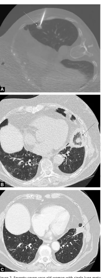 Figure 2. Seventy-seven-year-old woman with single lung metastasis from colorectal carcinoma of the left lower lobe that was  treated by radiofrequency ablation (RFA)
