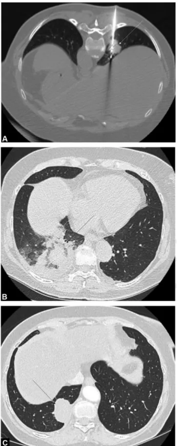 Figure 3. Seventy-year-old man with single lung metastasis from colorectal carcinoma in the right lower lobe that was treated  by microwave ablation (MWA)