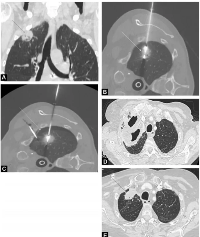 Figure 4. Sixty-two-year-old man with a primary lung tumor in the right upper lobe who developed bronchopleural fistula after  microwave ablation (MWA)