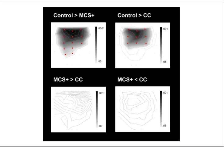 Figure 3.  Differences in ERP responses between groups. This figure illustrates significantly higher (&gt;) or lower (&lt;) P3 amplitudes (in  the active condition) when comparing groups (control, MCS+, and CC [covert cognition])