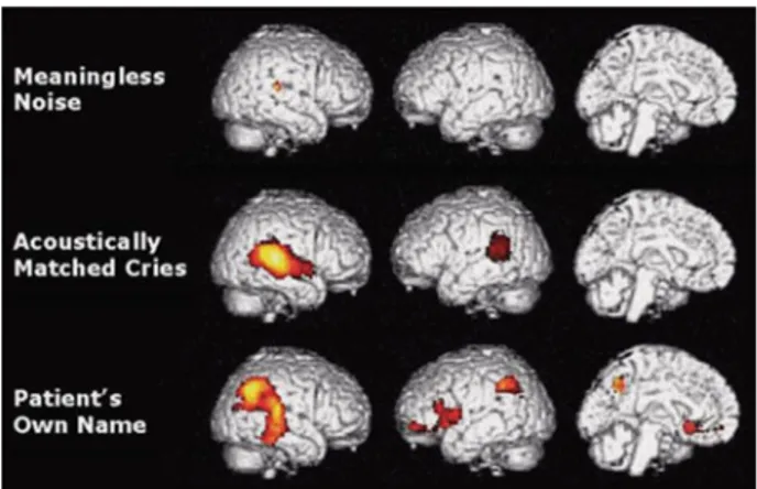 Fig. 2.5 Brain activations during presentation of noise, baby cries, and the patient’s own name.