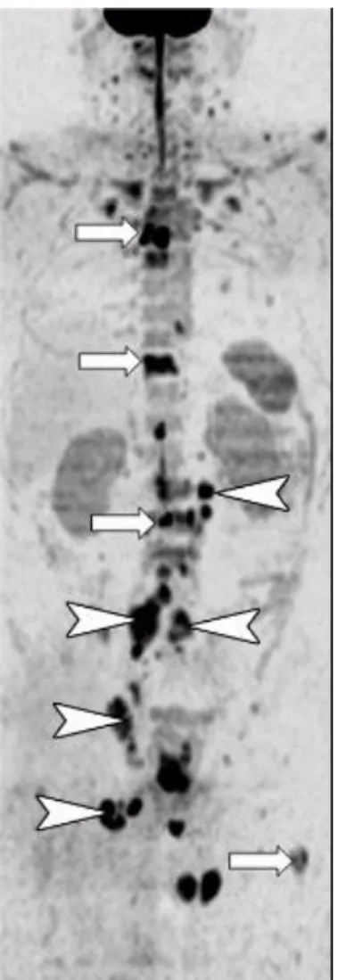 Figure 4 92  : Multiples hypersignaux (flèches) témoignant de métastases osseuses dans le cadre  d’un cancer de la prostate (IRM de diffusion corps entier) 