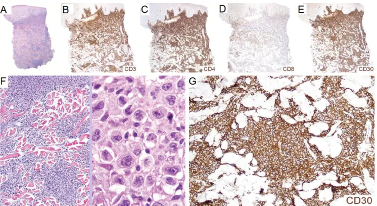 Figure 4 : Papulose lymphomatoïde de type C :  