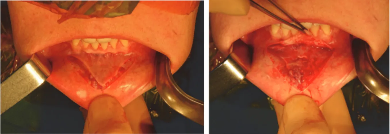 Figure 1 et 2. Tracé de l’incision vestibulaire à la lame froide en « V33 » et décollement sous  muqueux