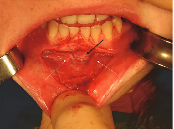 Figure  4.  Vue  de  face  de  la  mandibule  montrant  le  tracé  d’ostéotomie  avec  les  distances  à  respecter