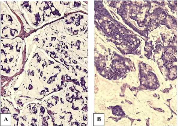 Figure 11 : Adénocarcinome mucineux (A : HES, x20 ; B: HES, x40). 