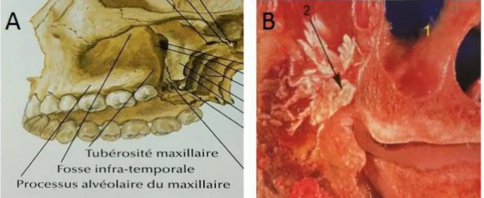 Figure 1: tubérosité maxillaire. (A) schéma représentant la région tubérositaire. (B) coupe  sagittale anatomique de la tubérosité maxillaire