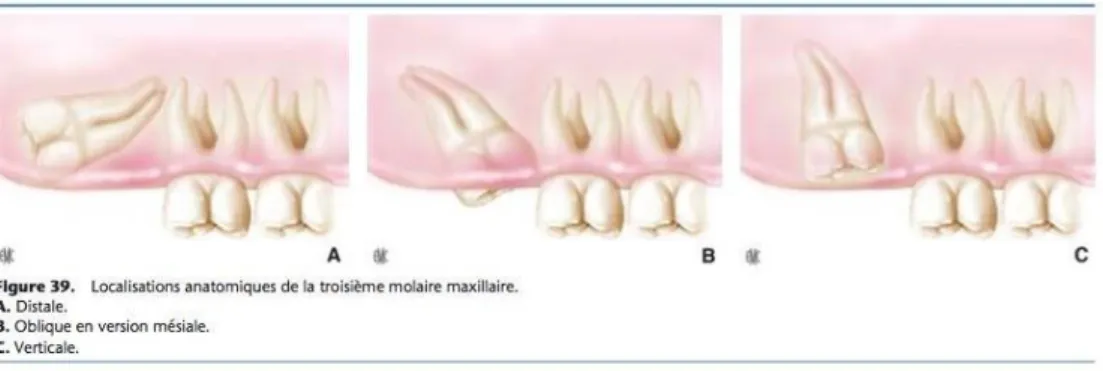 Figure 15 : classification représentant les principales orientations de la troisième molaire  maxillaire incluse