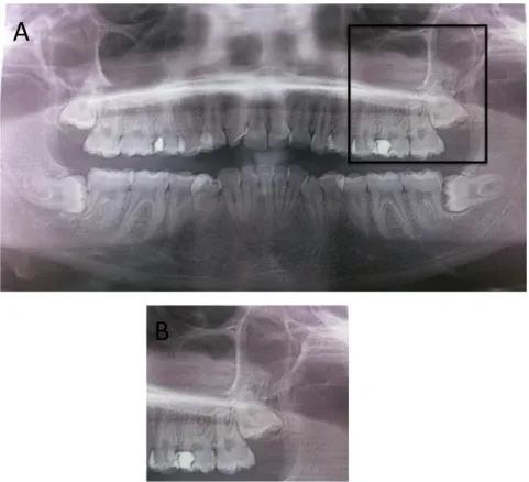 Figure 16 : panoramique dentaire pré-opératoire des 4DDS. 38 et 48 sont en position  horizontale (A)