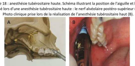 Figure 18 : anesthésie tubérositaire haute. Schéma illustrant la position de l’aiguille et le nerf  visé lors d’une anesthésie tubérositaire haute : le nerf alvéolaire postéro-supérieur (A)
