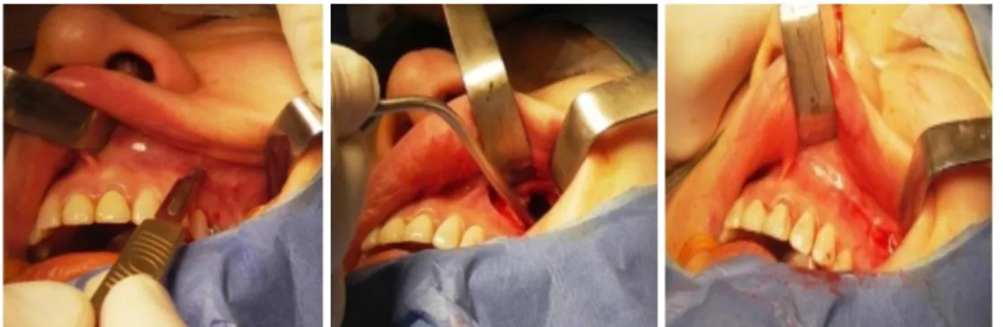 Figure 26 : intervention de Caldwell-Luc. Photos prises lors de la réalisation de l’incision (à  gauche), l’abord vestibulaire (au milieu) du sinus maxillaire, et la suture (à droite) lors d’une 