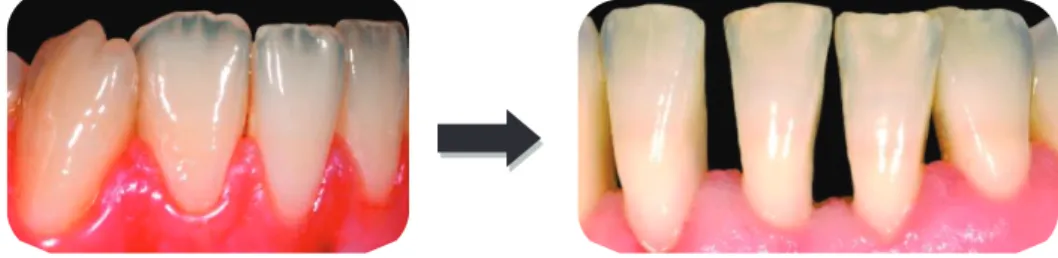 Figure 19 : Différence de translucidité des bords libres des incisives mandibulaires. 