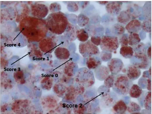 Figure 1. Lipophages scoring (intracellular lipid in BAL macrophages detected by Oil  Red O staining) 
