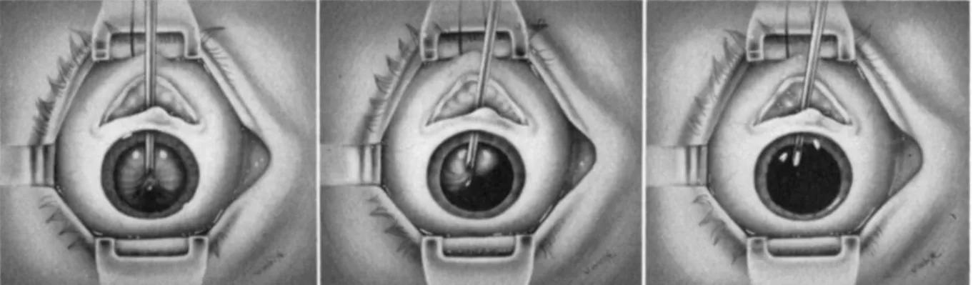 Figure 21 : technique d'aspiration des cataractes molles à l'aiguille par Sheie, 1960 